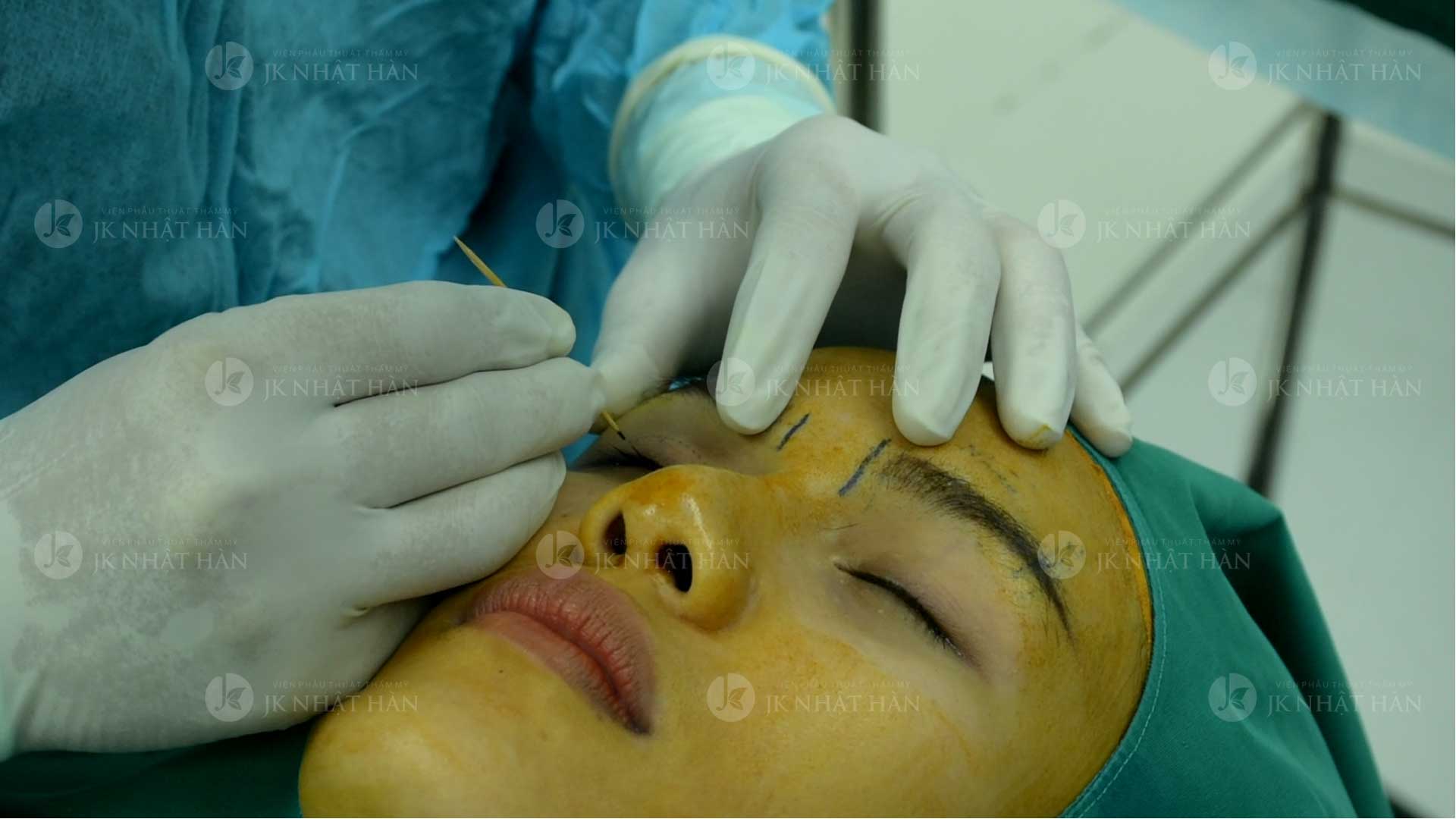 bác sĩ tạo hình mắt 2 mí không phẫu thuật tại viện thẩm mỹ jk nhật hàn